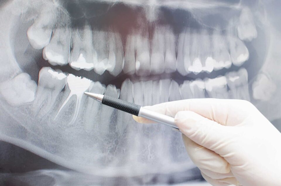 Dental implant in Laurel, MD