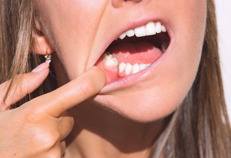 Teeth Implant Treatment in Laurel, MD