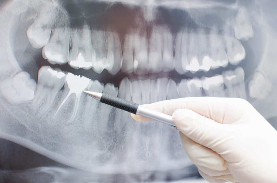 dentist pointing pen at tooth on digital x-ray